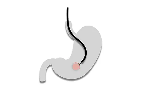 Endoscopia digestiva avanzada especialidades del instituto clinico del aparato digestivo