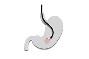 Endoscopia digestiva avanzada especialidades del instituto clinico del aparato digestivo home