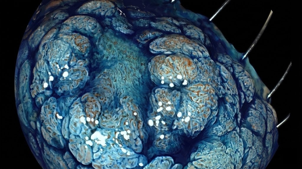 Disección submucosa de un pólipo de colon