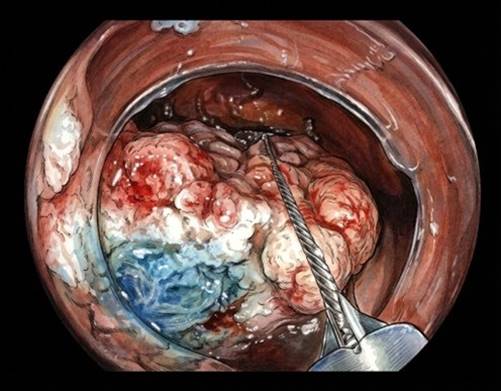 Lesión extensa en el ciego, resecada mediante RME fragmentada con un asa de diatermia.