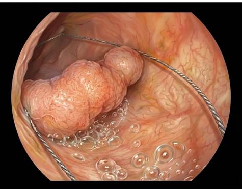 Pólipo de colon resecado con asa mediante técnica en inmersión (underwater EMR)