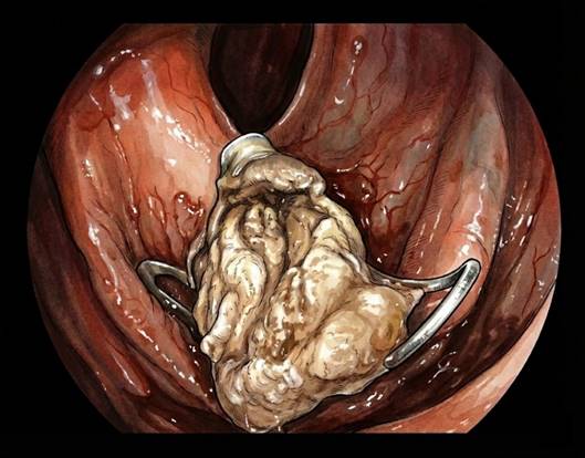 Cambios asociados a la extirpación de una lesión mediante RTME o resección full-thickness. Se puede observar los vértices metálicos del clip en los bordes del área resecada.