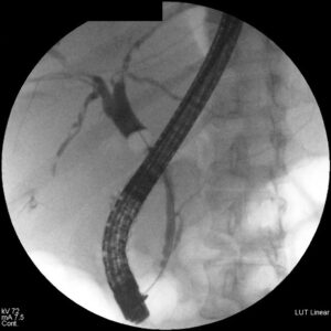 Árbol biliopancreático durante una CPRE.