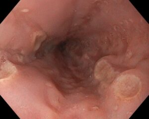Úlceras esofágicas en paciente con esofagitis herpética