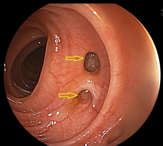 Diverticulitis de colon