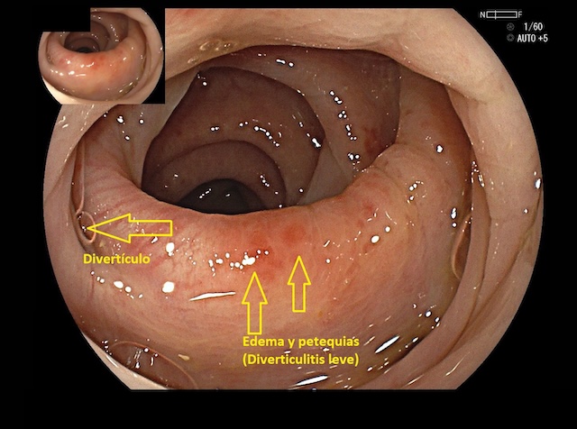 Diverticulitis aguda leve