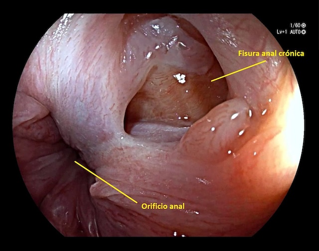 Foto Fisura anal crónica