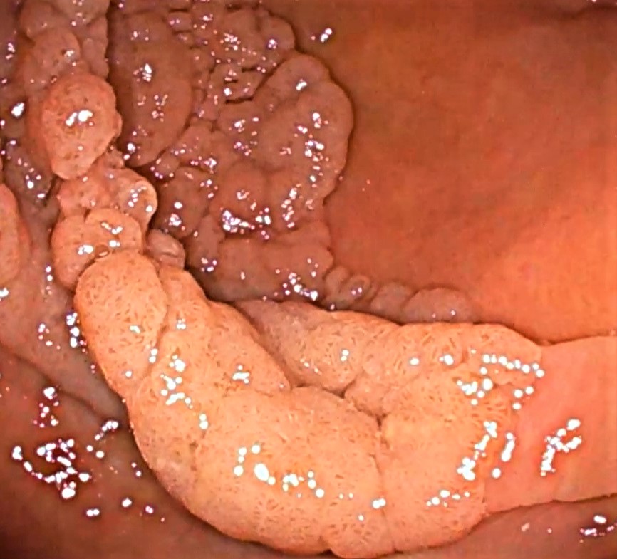 Lesion de extension lateral en el colon granular homogenea efe