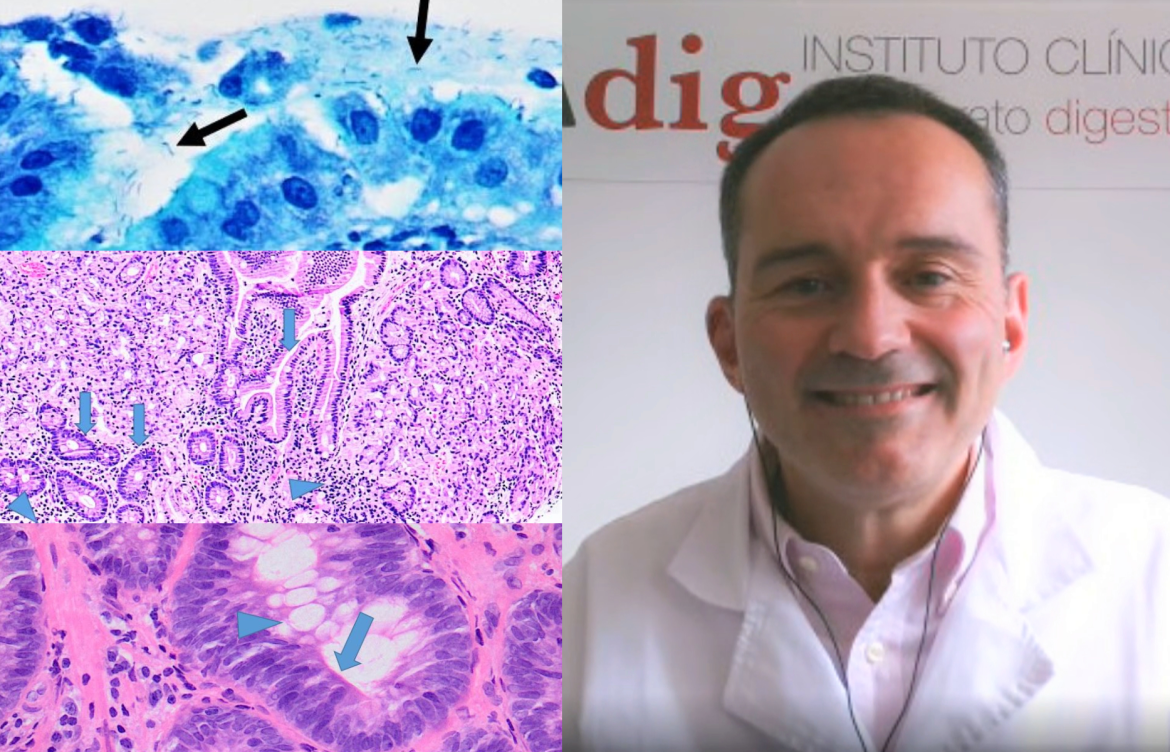 El doctor Marin Gabriel explica las caracteristicas de las lesiones en el estomago que conllevan un cancer gastrico efe 1170x752