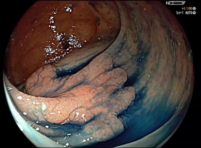 Pólipo adenomatoso morfología no granular. Cromoendoscopia con índigo carmín.