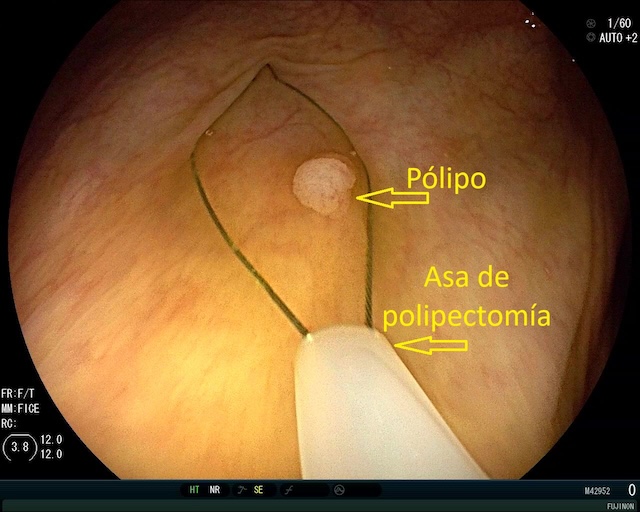 Pólipo adenomatoso de pequeño tamaño antes de su resección con asa fría.