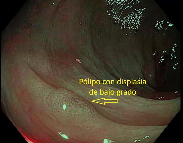 Adenoma con displasia de bajo grado. Cromoendoscopia digital con NBI