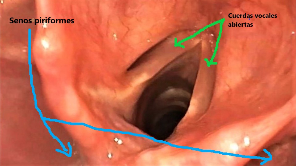 Senos piriformes y cuerdas vocales