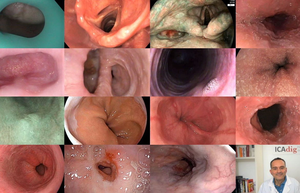 endoscopia bucal y esofagica efe 1170x752