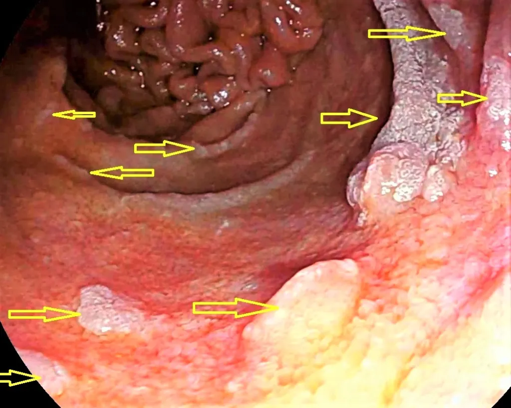 Adenomas duodenales multiples PAF 1024x818