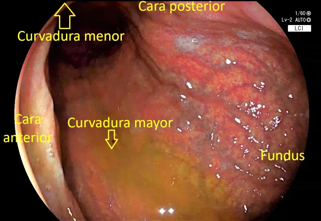 Caras estomago vision directa alta 1024x705