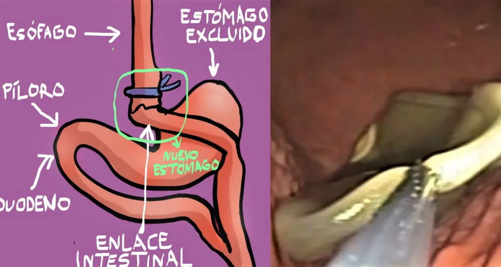 Cirugia bariatrica y retirada endoscopica de balon intragastrico efe 1024x545