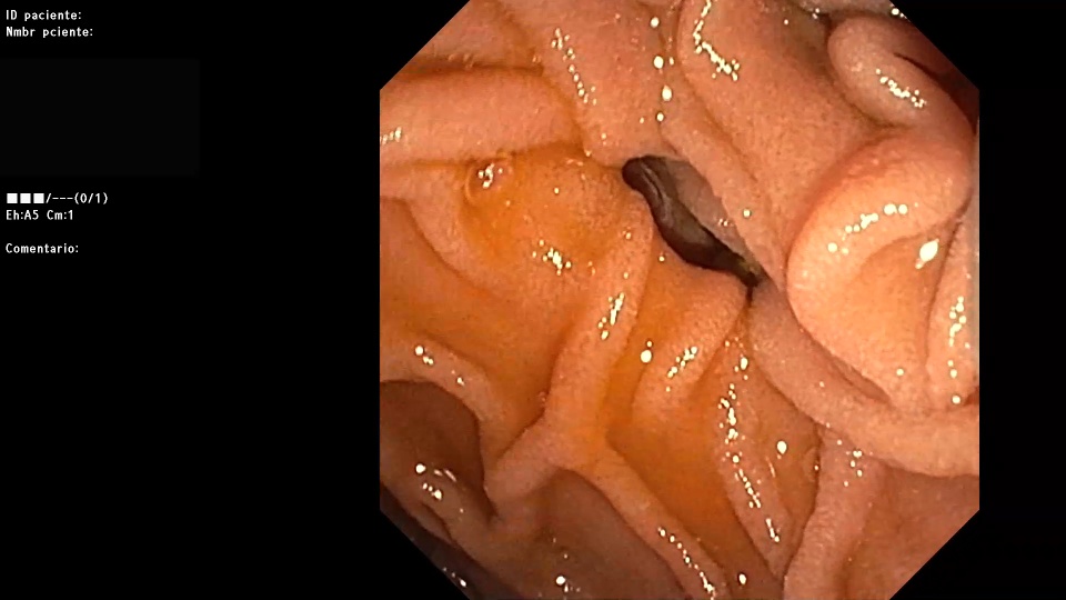 Diverticulo duodenal efe