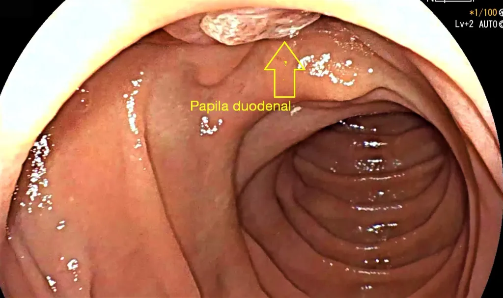 Papila duodenal 1 1024x607