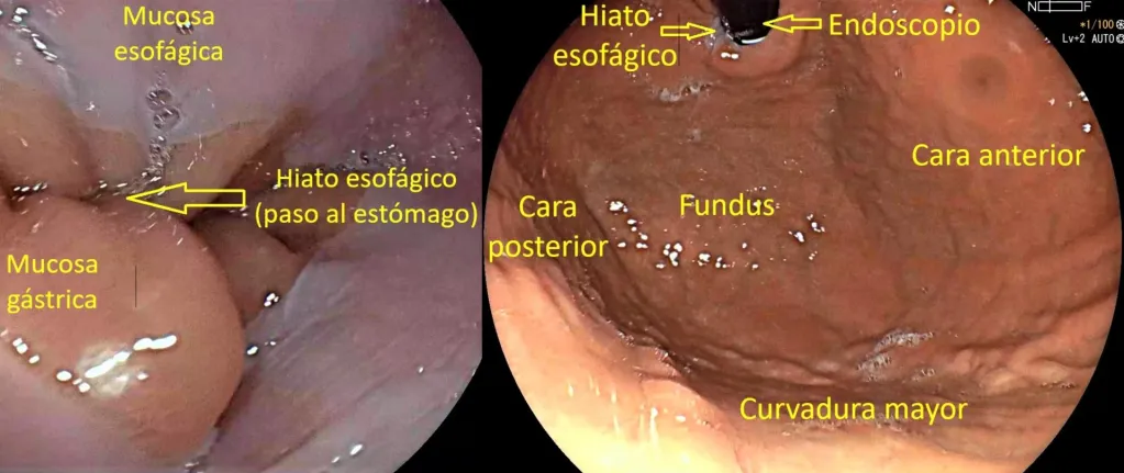 Zonas del hiato esofagico e interior del estomago efe 1024x431