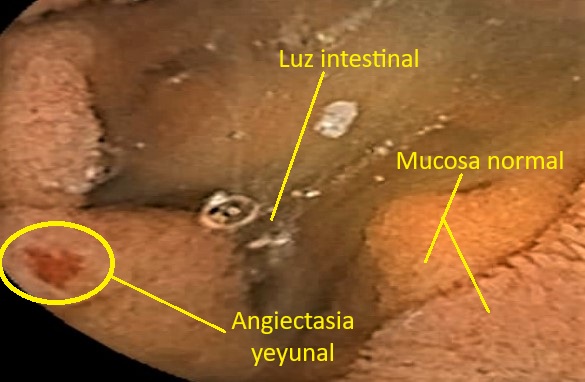 Angiectasia en el intestino delgado efe 1