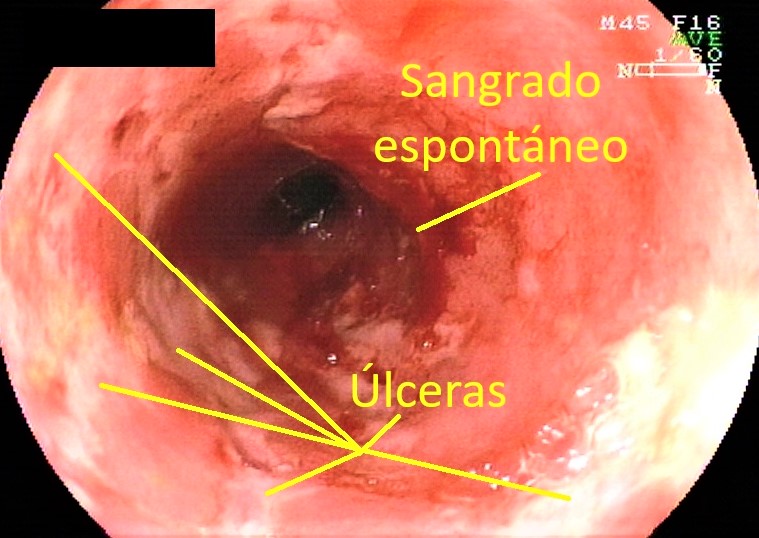 Colitis ulcerosa ulceras sangrado espontaneo