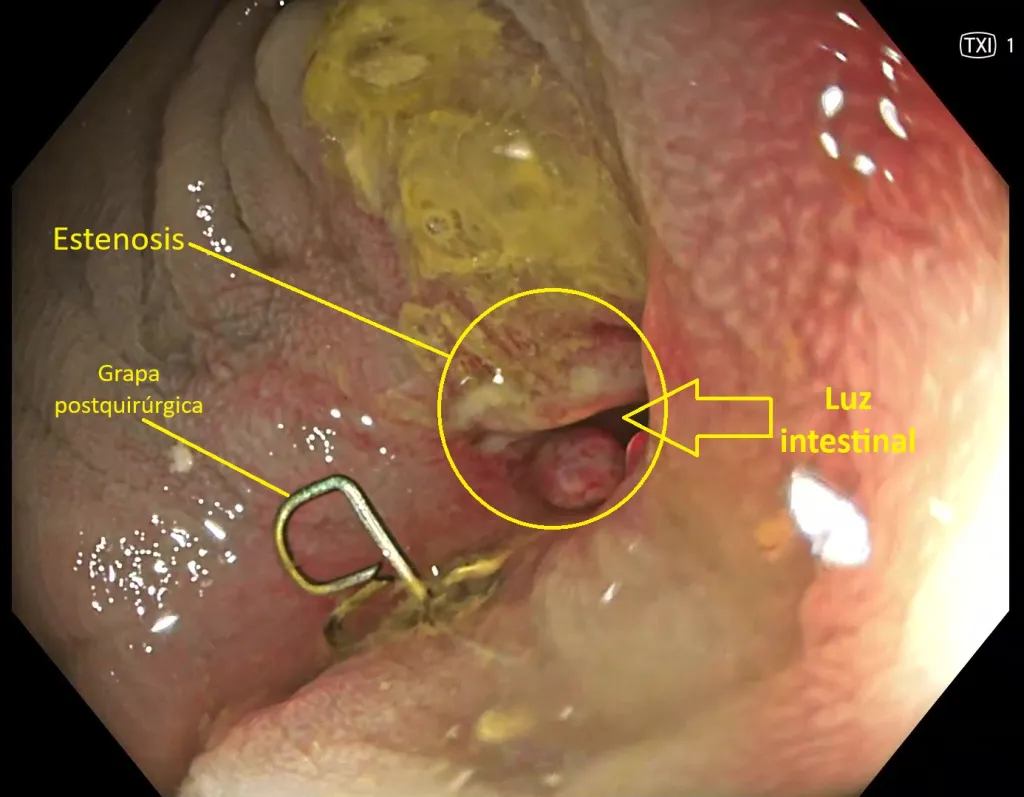 Estenosis colon 1024x797