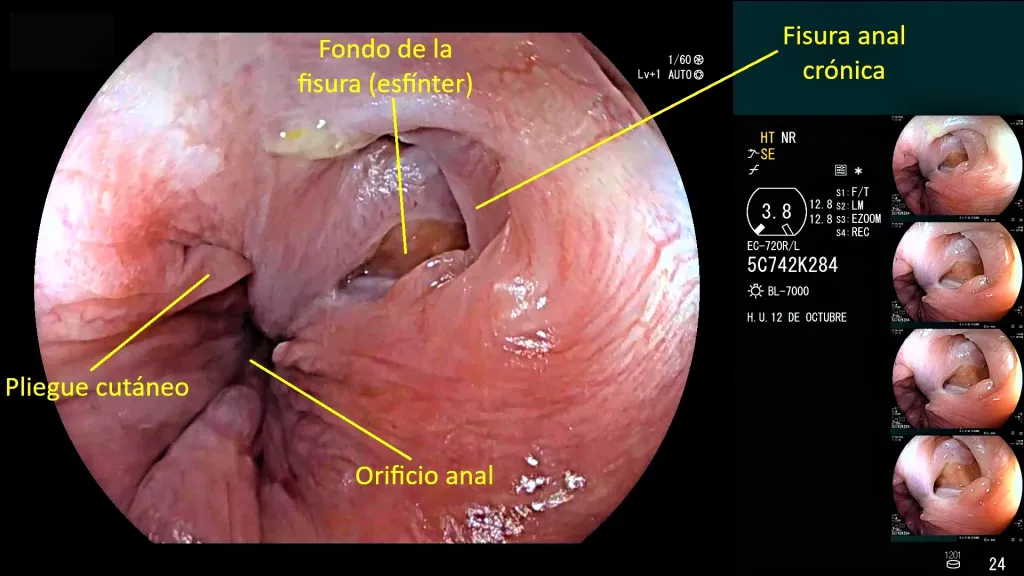 Fisura anal cronica 1 1024x576