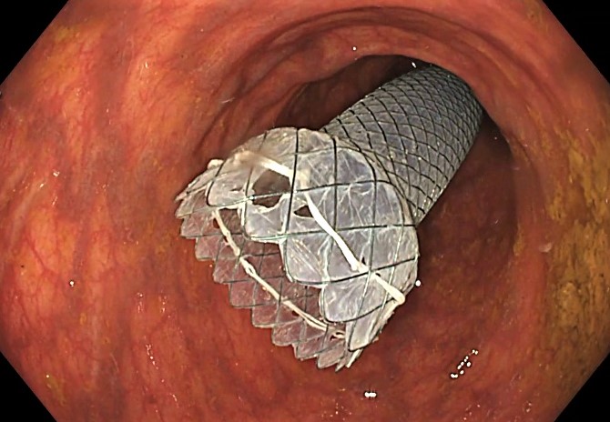 Protesis para estenosis en el colon efe