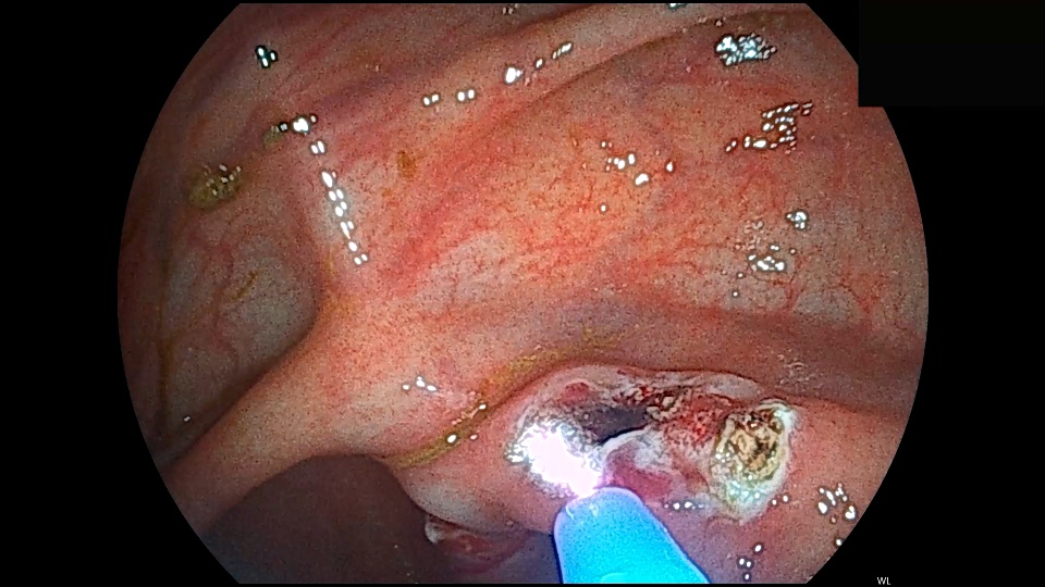 Tratamiento gas argon en el colon efe