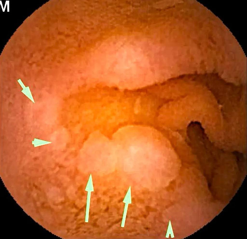 poliposis adenomatosa familiar efe 1024x992