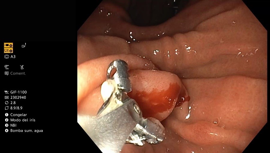 Biopsia de una úlcera gástrica pequeña en el antro gástrico.