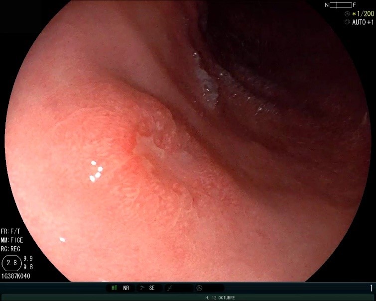 Cáncer gástrico ulcerado, precoz, de pequeño tamaño.