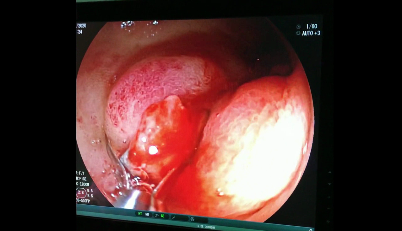 Vaso visible en una úlcera duodenal. Cierre con hemoclip.