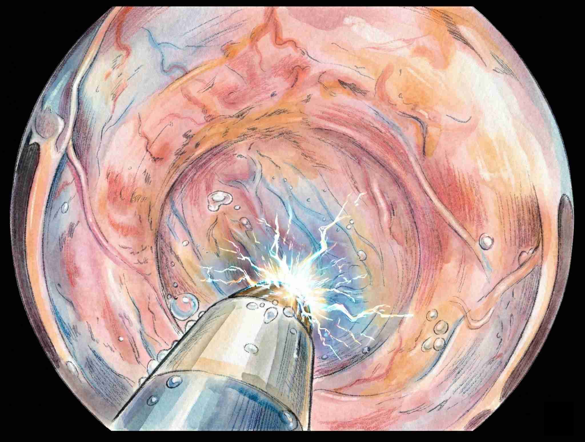 Endoscopia avanzada en cáncer gástrico precoz